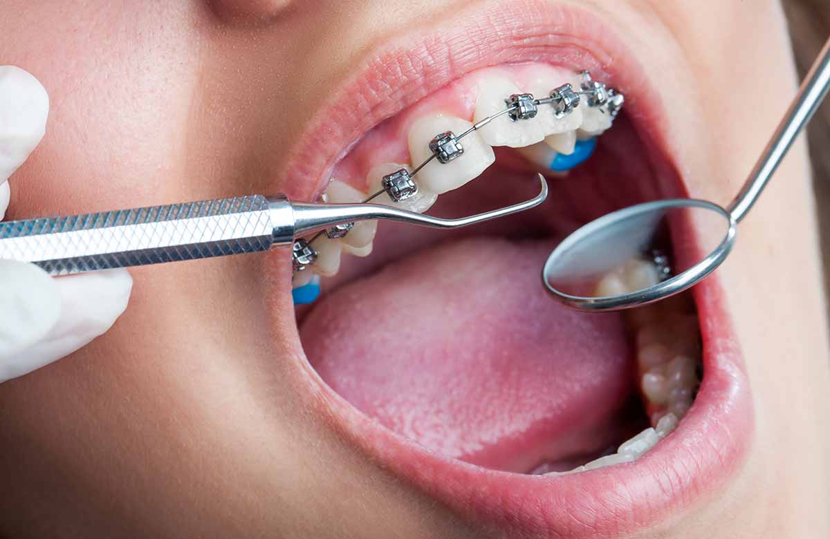Diş Çapraşıklıklarının Sebepleri